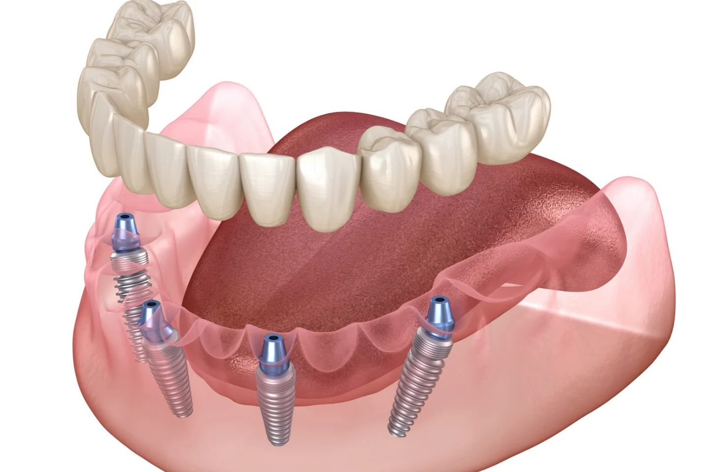 Can You Use HSA or FSA for Dental Implants? A Complete Guide