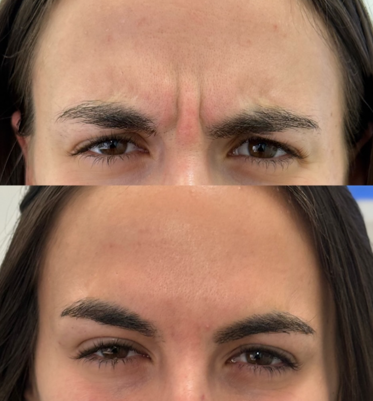 Before and after Botox treatment