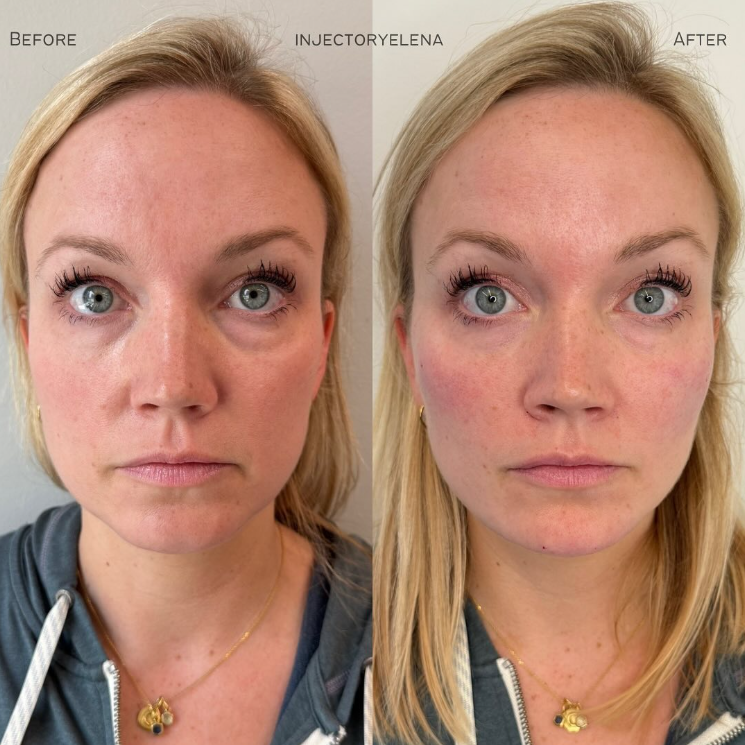 Before and after dermal filler treatment of the cheeks, chin, and jaw