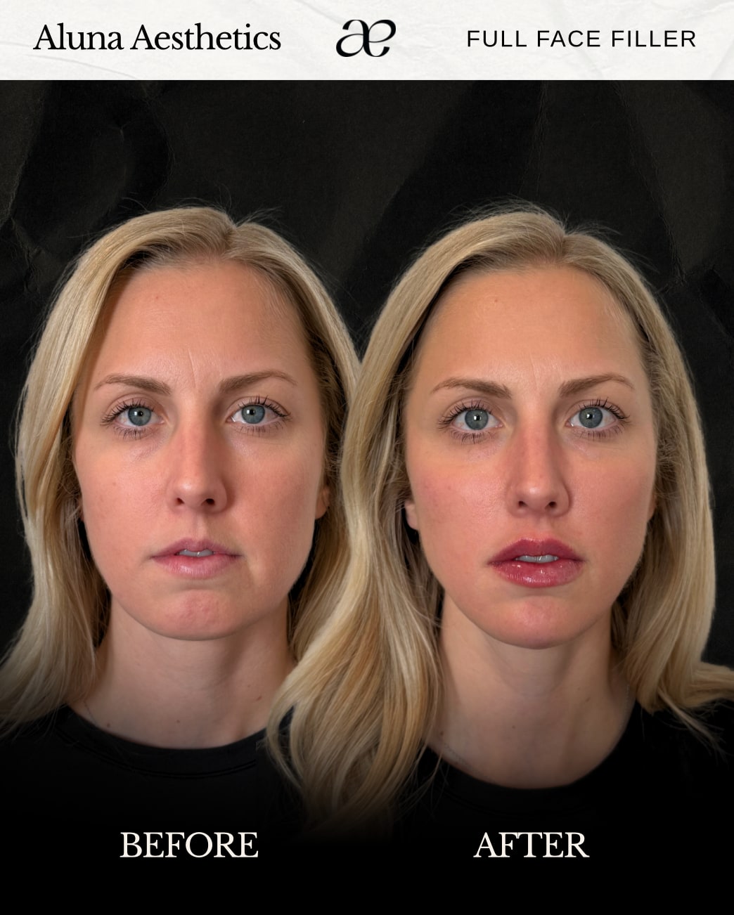 Before and after full face filler treatment at Aluna Aesthetics