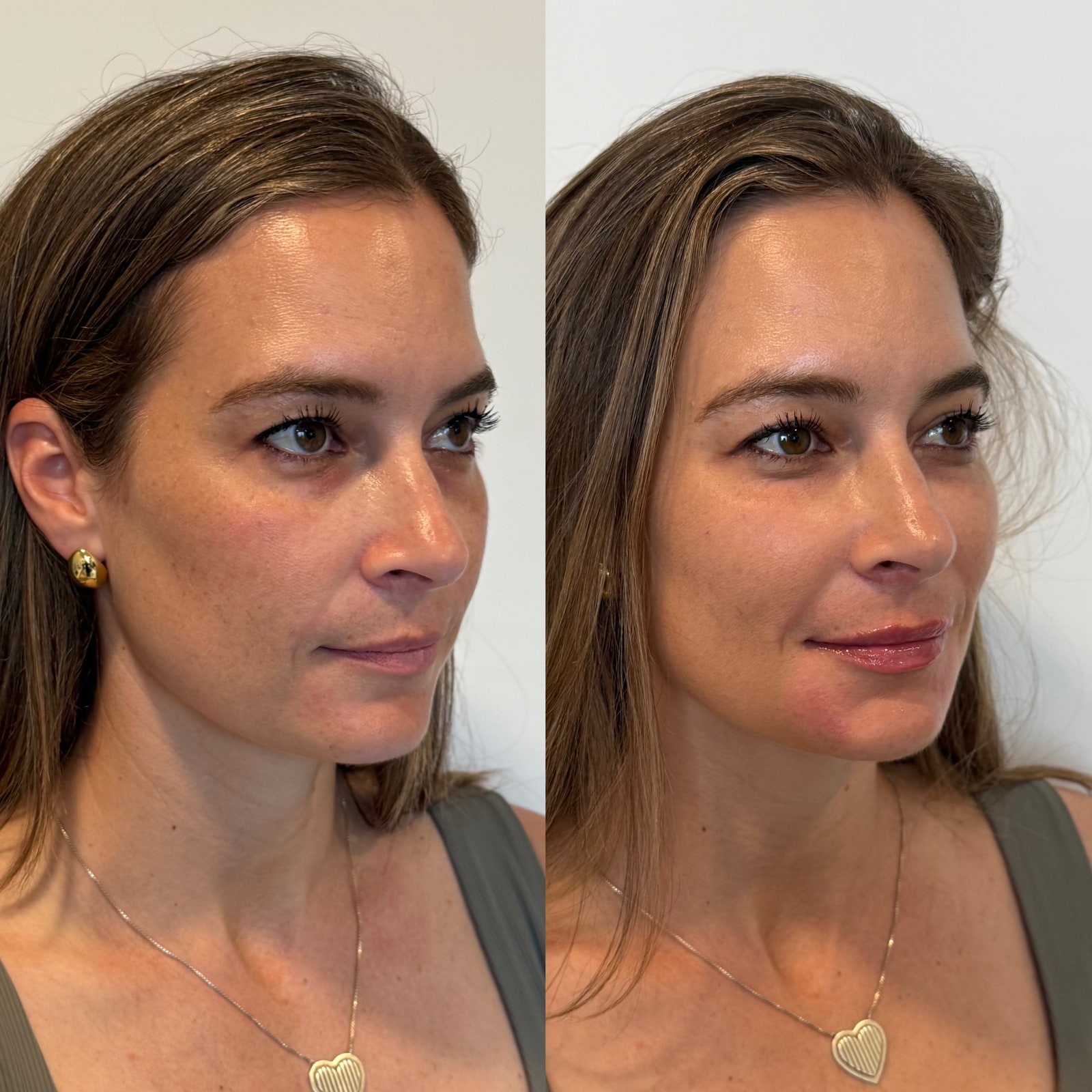 Before and after cheek and lip filler, three-quarter view, at Aluna Aesthetics