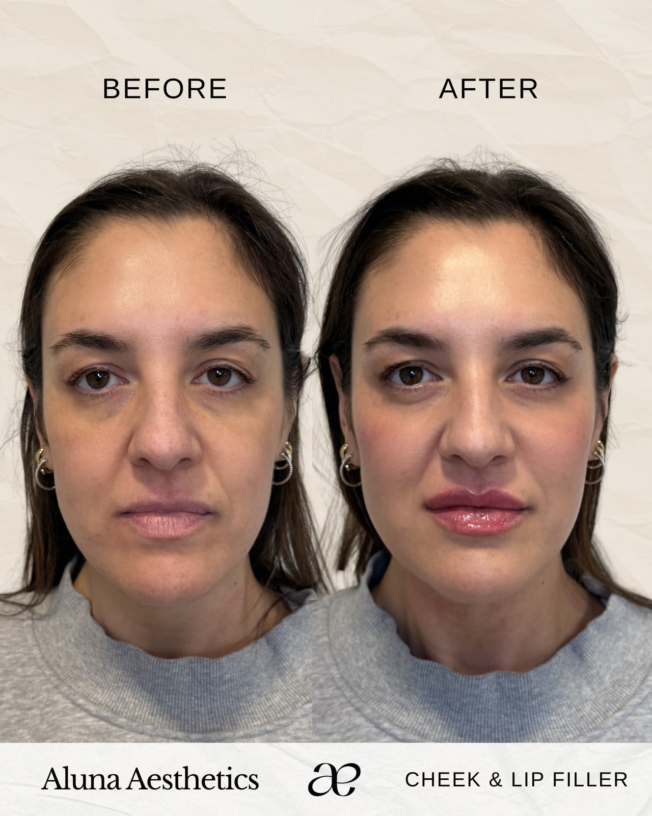 Before and after cheek and lip dermal filler treatment at Aluna Aesthetics