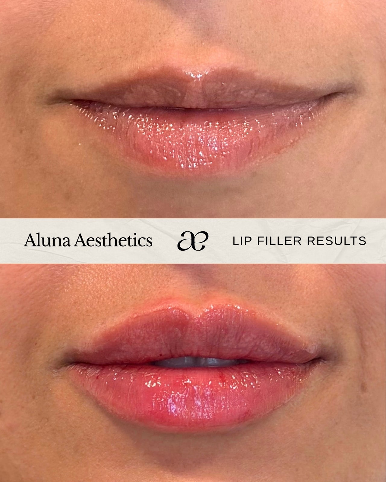 Before and after lip filler results at Aluna Aesthetics