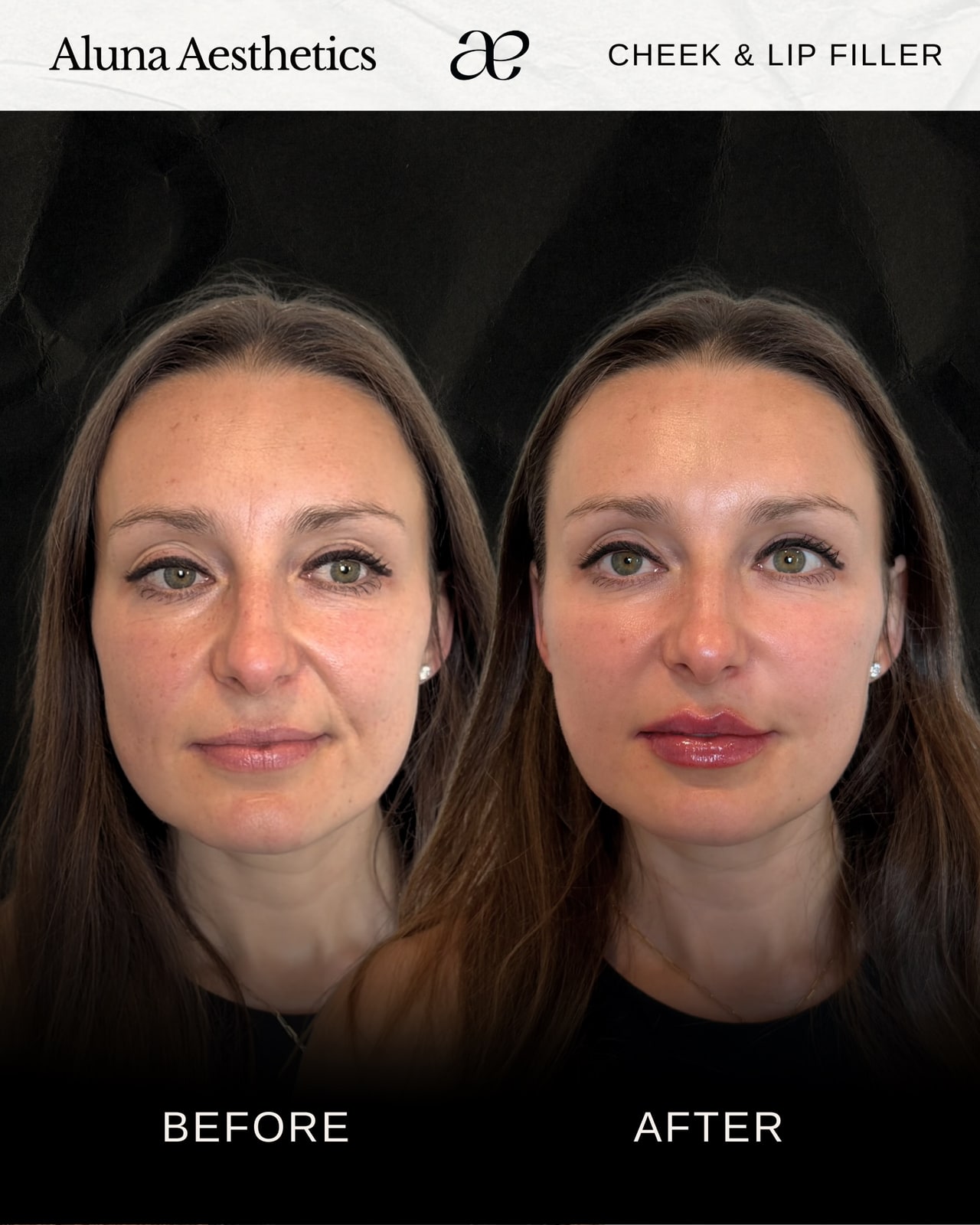 Before and after cheek and lip dermal filler results at Aluna Aesthetics
