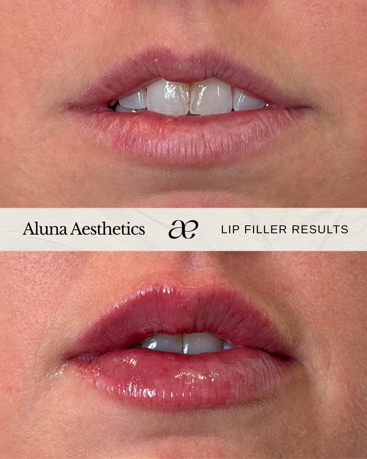 Before and after lip filler results at Aluna Aesthetics