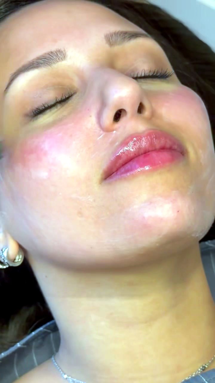 Radiant skin after microneedling with PRP at Aluna Aesthetics in Potomac, MD