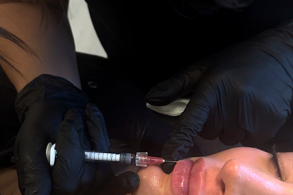 Lip filler injection treatment at Aluna Aesthetics in Potomac, MD
