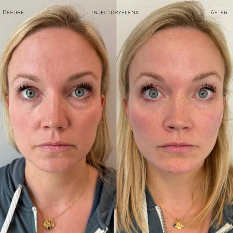 Before and after dermal filler treatment of the cheeks, chin, and jaw