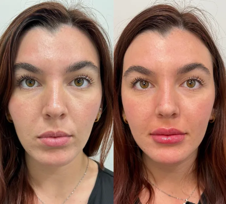 Before and after dermal filler lip and chin combination treatment