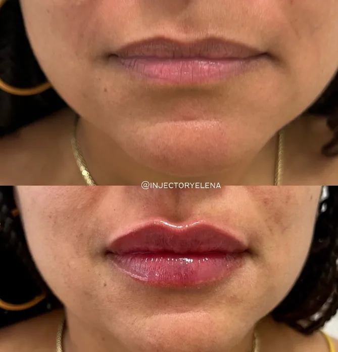 Before and after lip filler treatment