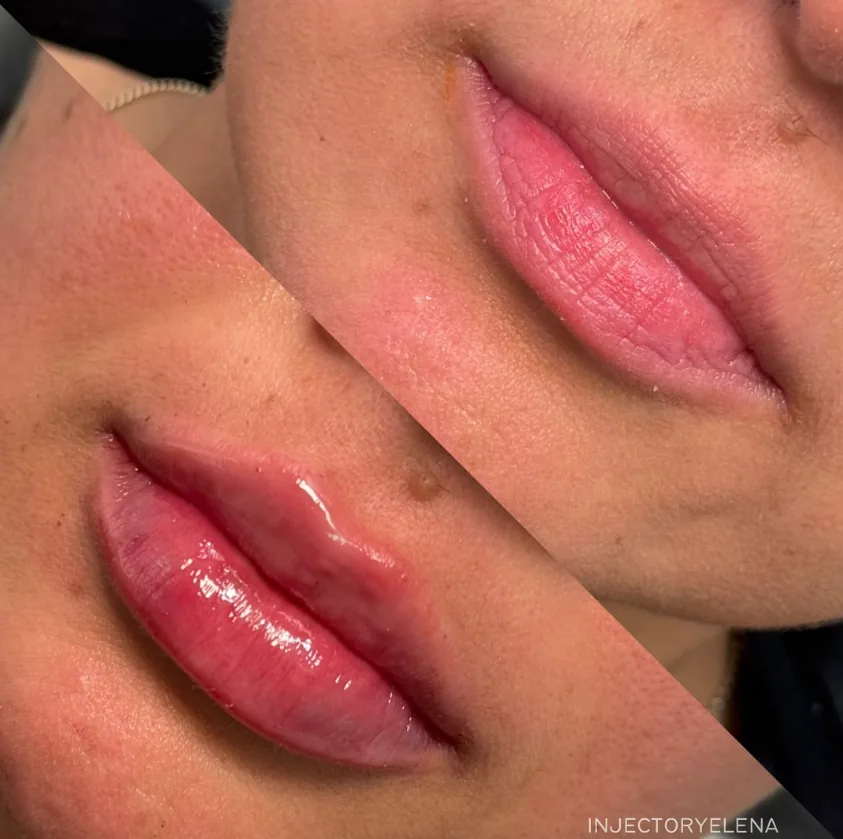 Before and after lip dermal filler treatment