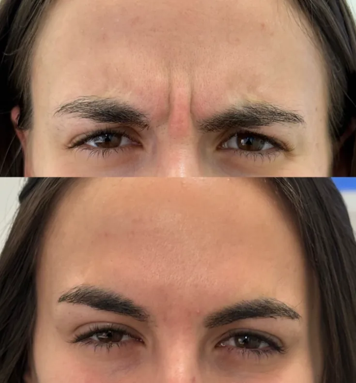 Before and after Botox treatment