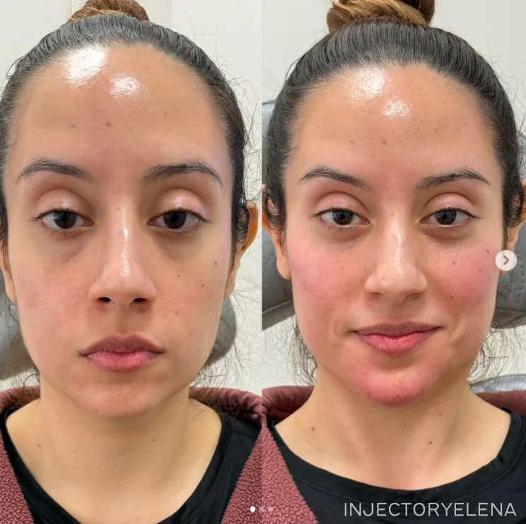 Before and after facial balancing treatment