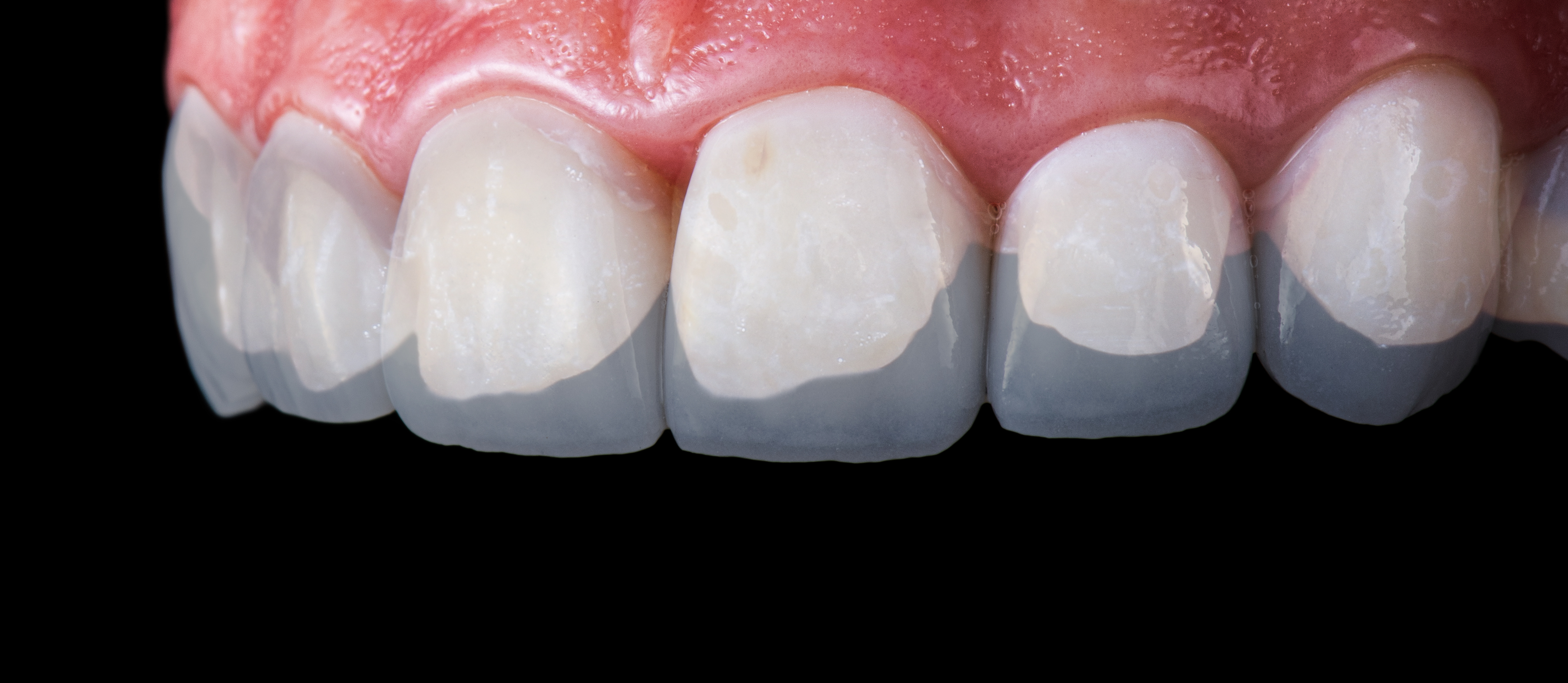 Veneers für Frontzähne im Zahnzentrum Nord Emden