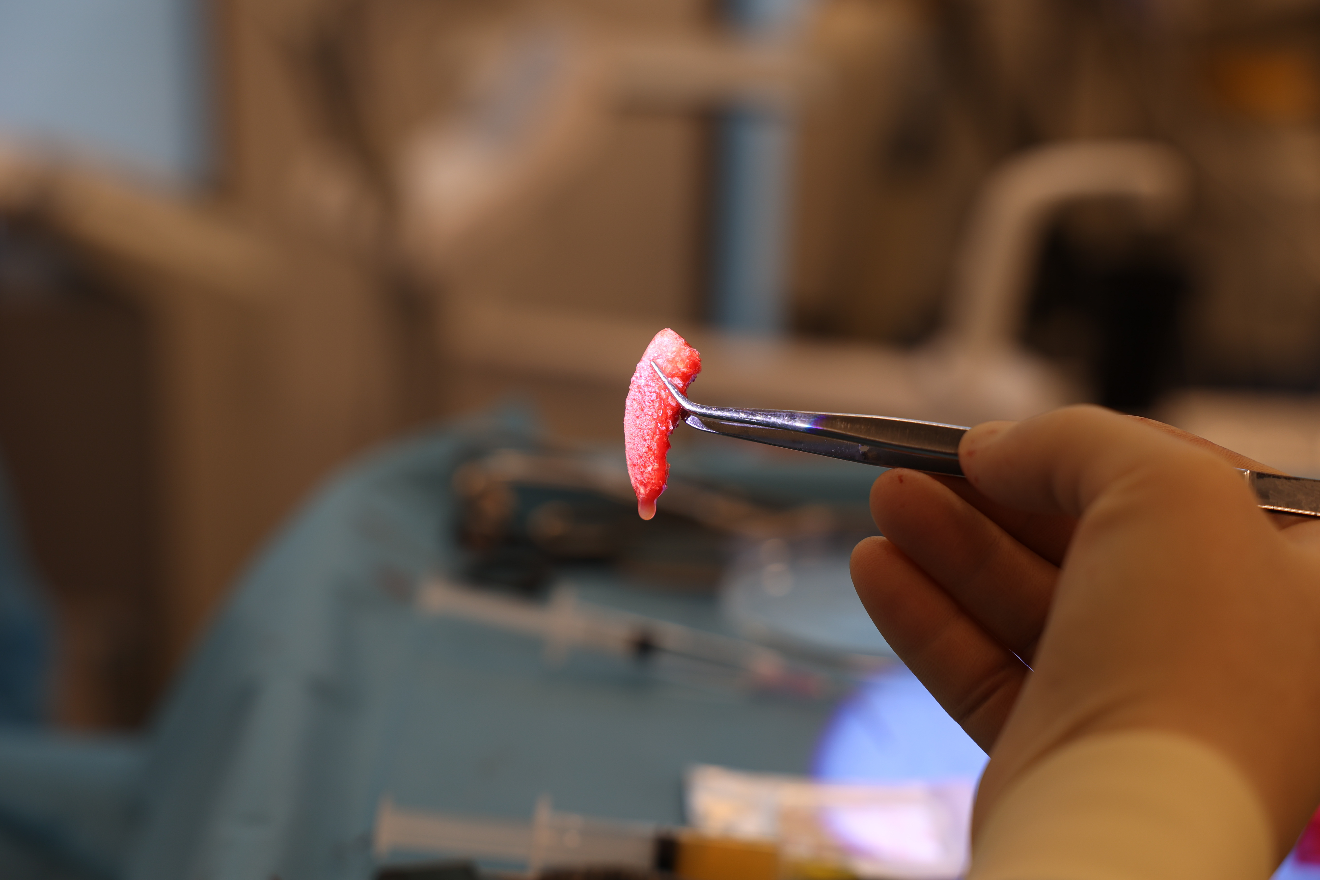 Knochenaufbau vor Implantatbehandlung im Zahnzentrum Nord Emden