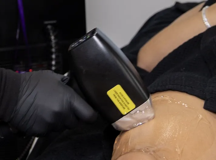 Laser treatment at Asha MedSpa