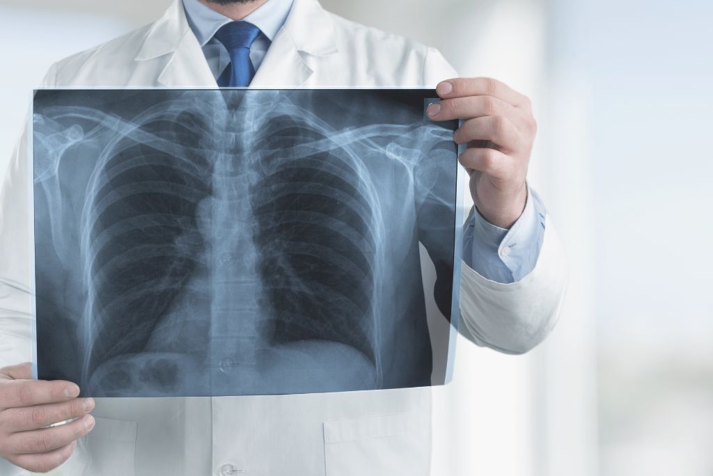 A COPD kivizsgálásához röntgenre is szükség van