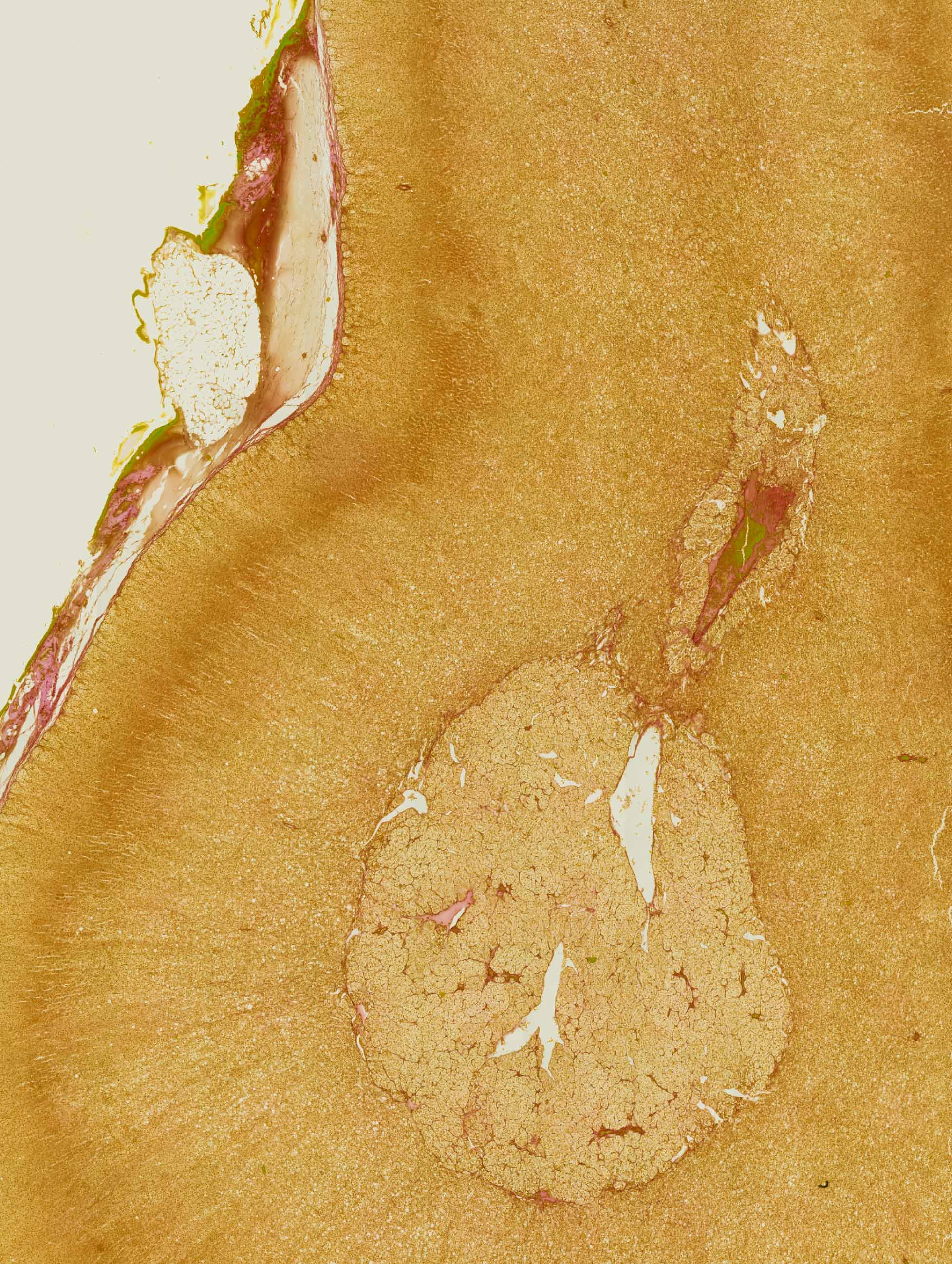 Exploring Addison's Disease and How to Manage It