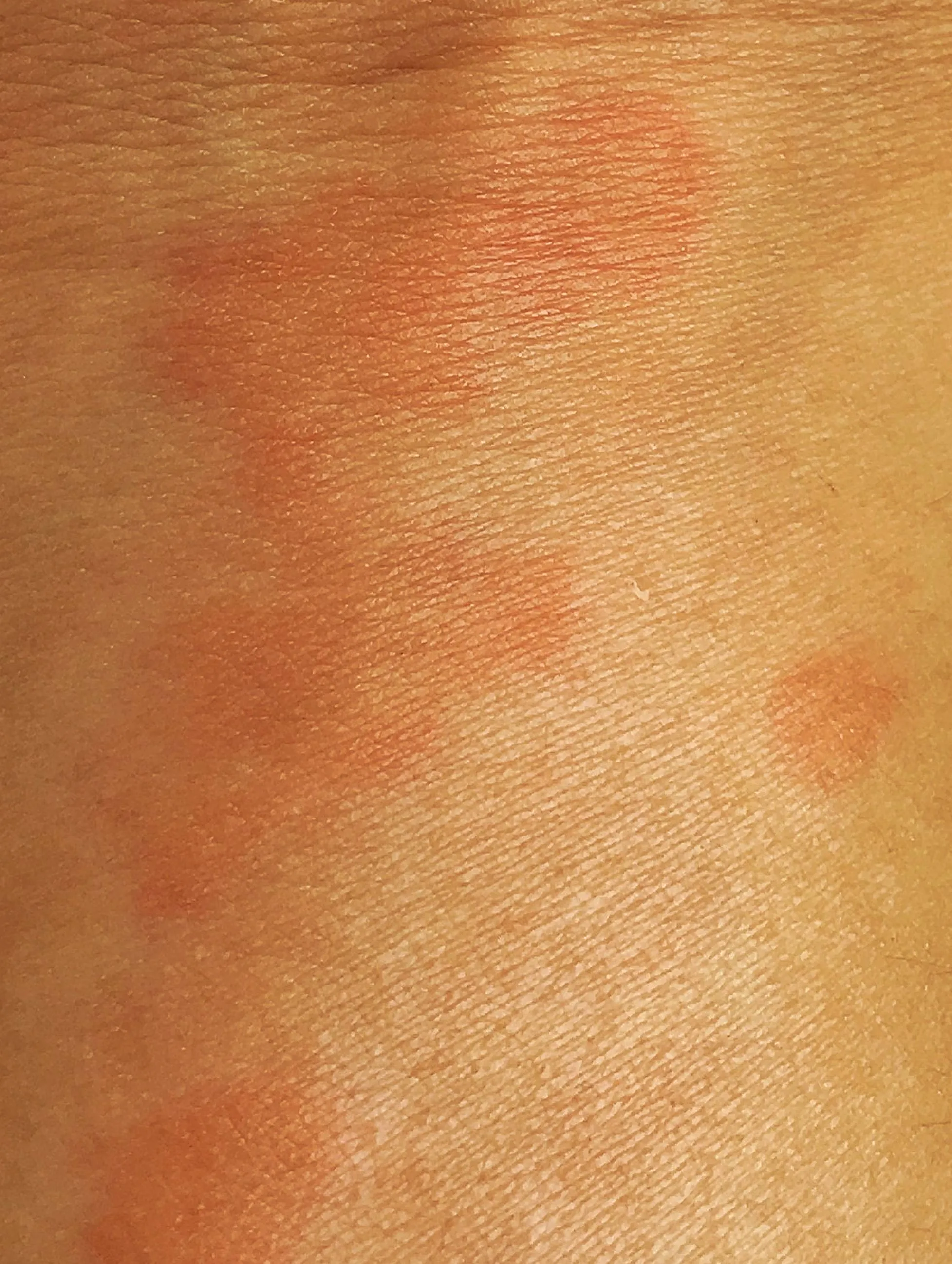 Understanding Lupus and How to Manage Its Symptoms