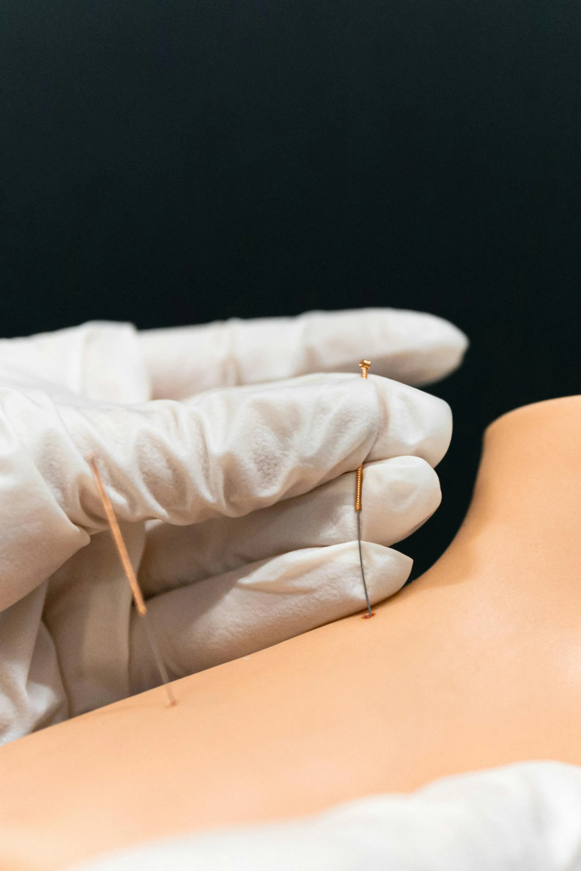 Fizjoterapeuta wykonuje suchą igłoterapię mięśni pleców u pacjenta z bólem