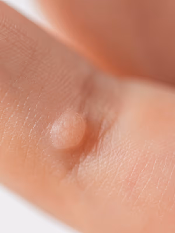 Nahaufnahme eines Fingers mit einer kleinen Warze