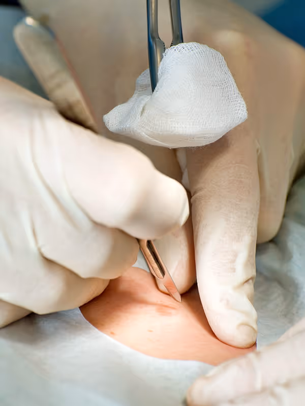 Nahaufnahme einer dermatologischen Operation. Die Patientin liegt am OP Tisch