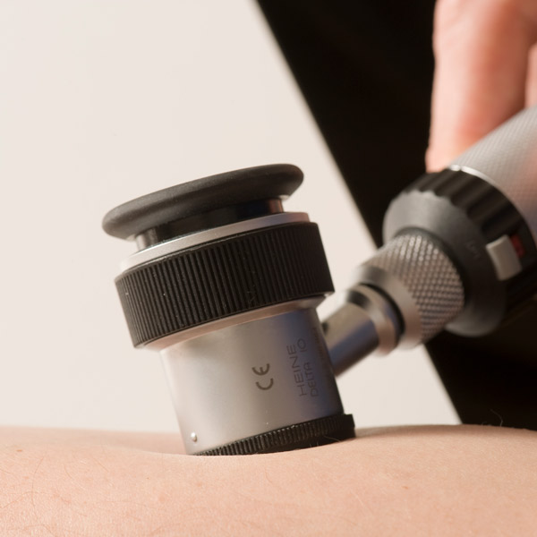 Nahaufnahme eines Hautbereichs, auf den ein Dermatoskop aufgesetzt wird. Eine Hand hält das silberfarbene Gerät mit schwarzem Griff und legt es auf die Haut auf. Die Szene zeigt eine typische Untersuchungssituation in einer Hautarztpraxis.
