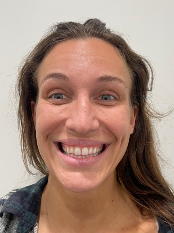 after image of botox results