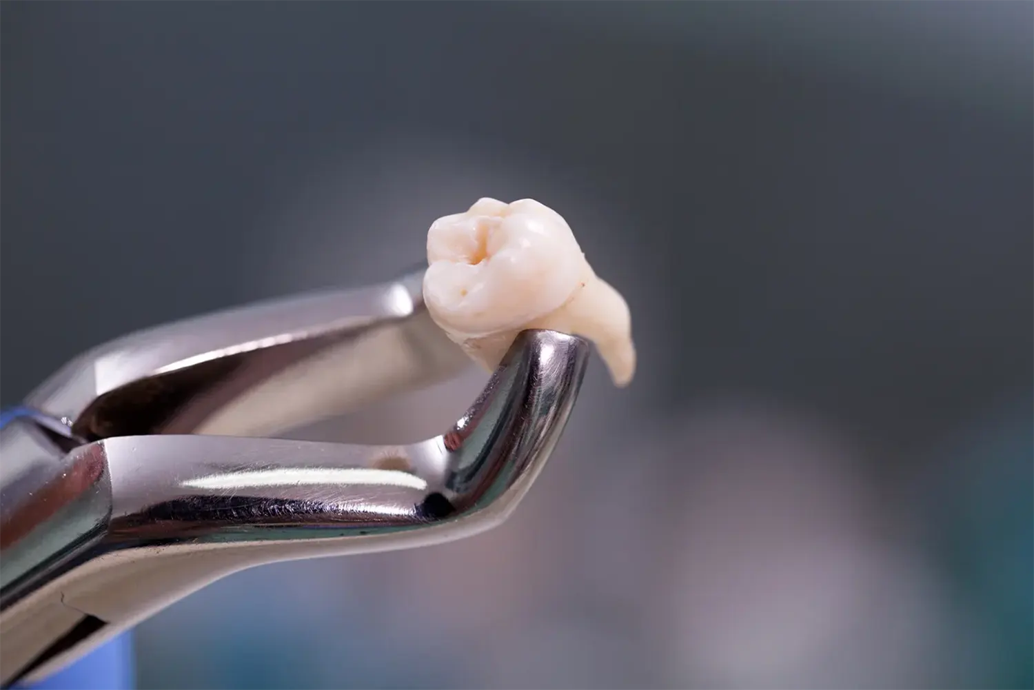 What to Do if Your Tooth Falls Out