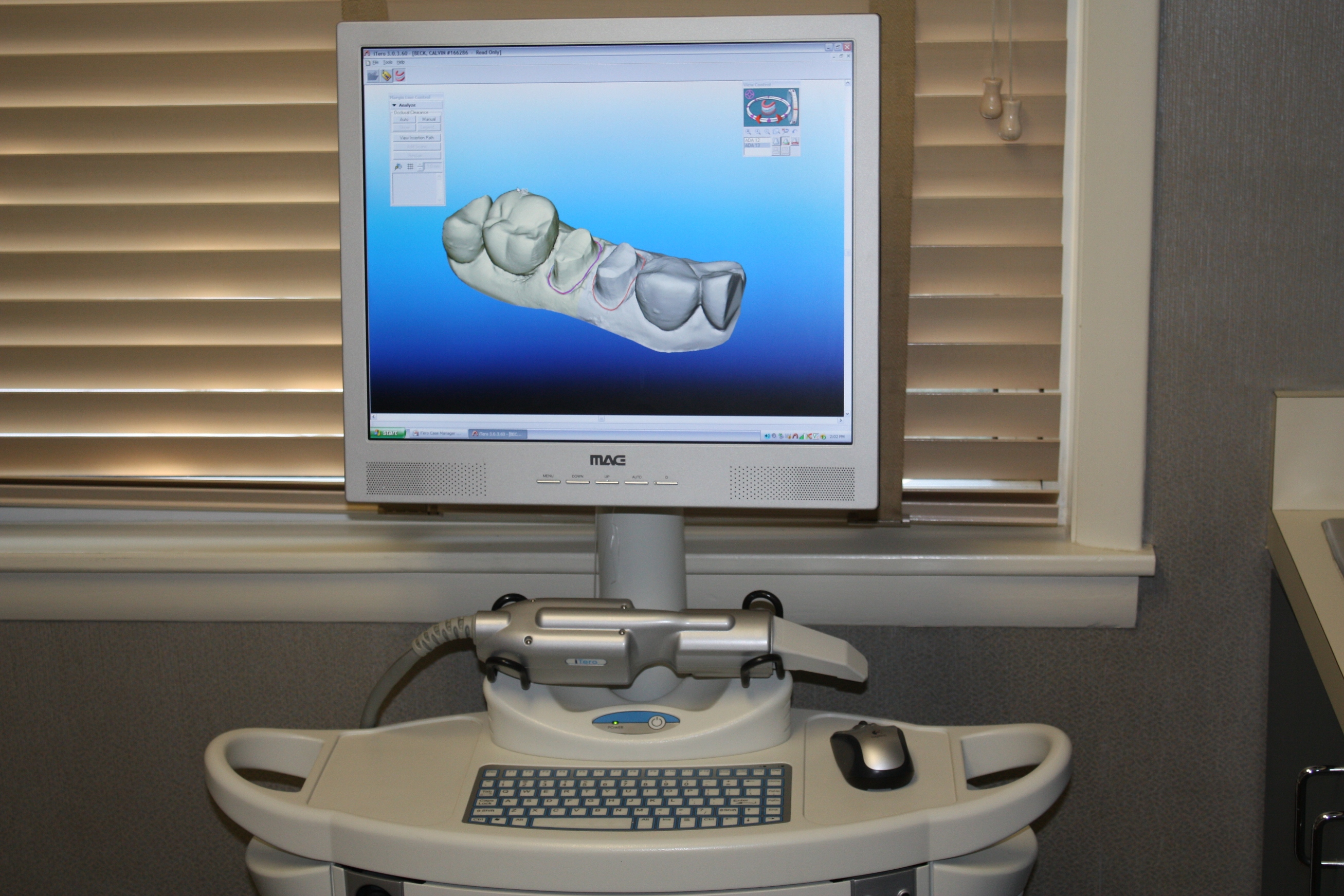 iTero Dental Digital Oral Scanner
