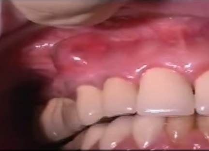 What is a Tooth Abscess? (Updated)