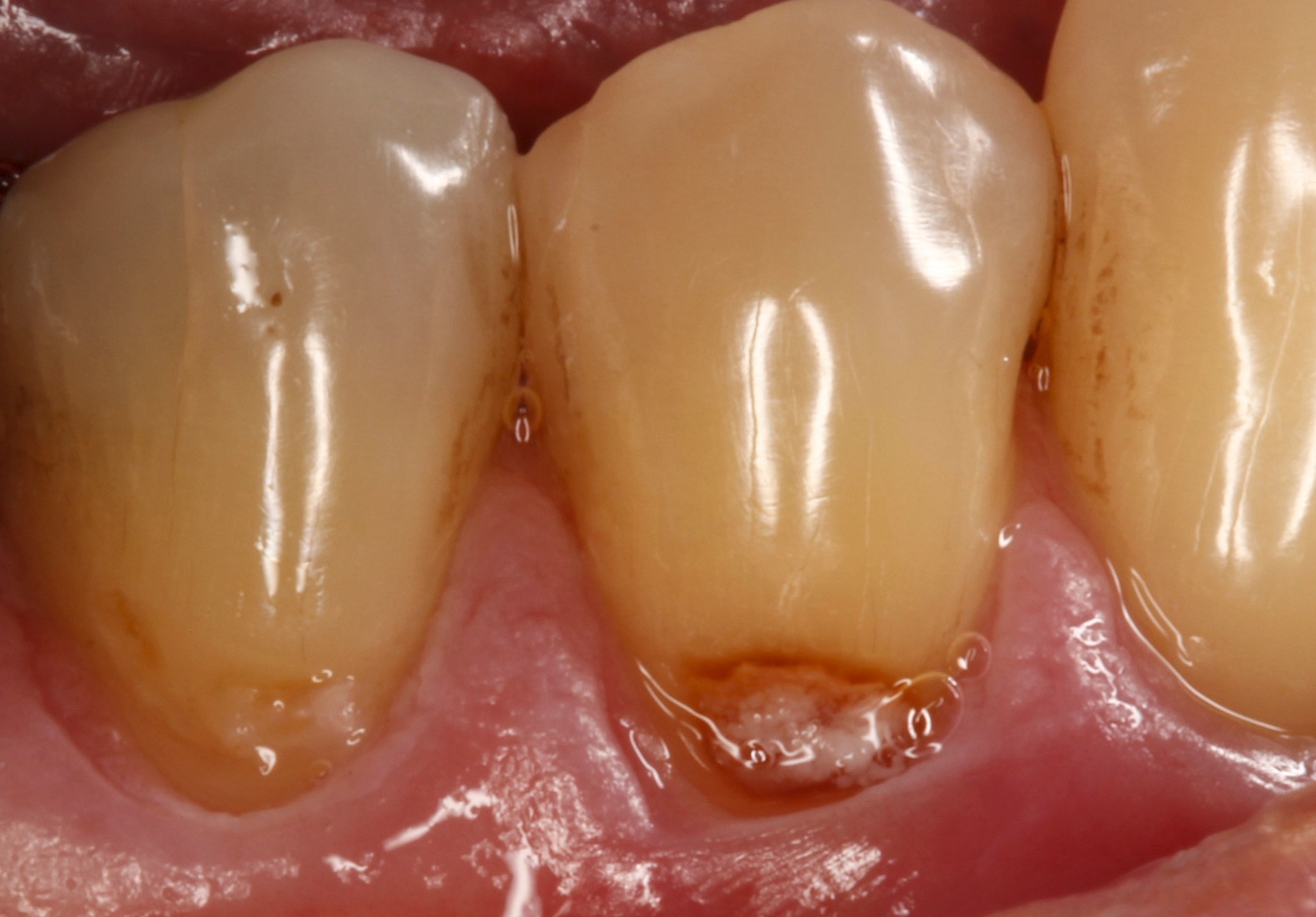 How Can I Tell if I Have a Cavity?