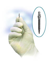 How to Maximize Your Chances for Dental Implant Retention