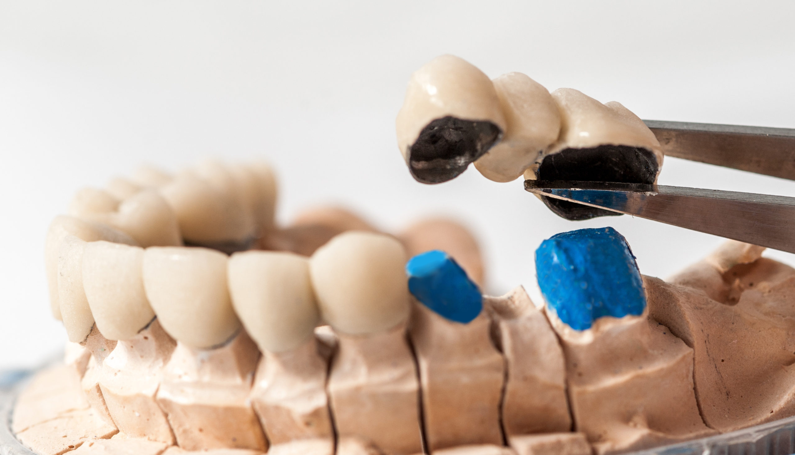 Can Teeth Under a Fixed Bridge Get Infected?