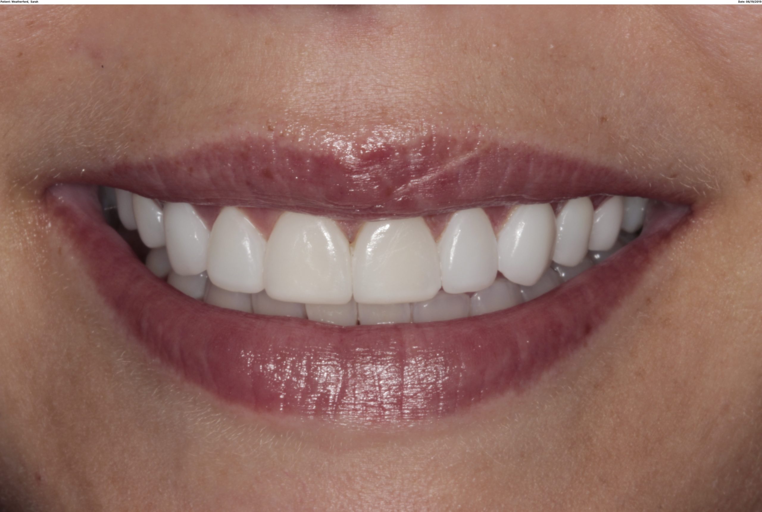 How to Avoid Cavities With Veneers