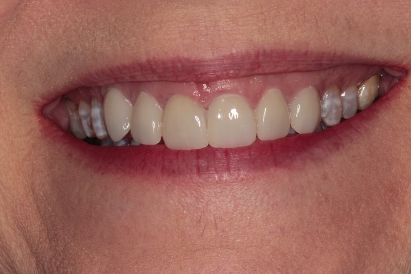 Virginia’s Story: How Veneers Made the Ultimate Difference
