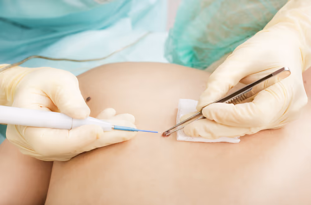 skin cancer removal in American Fork