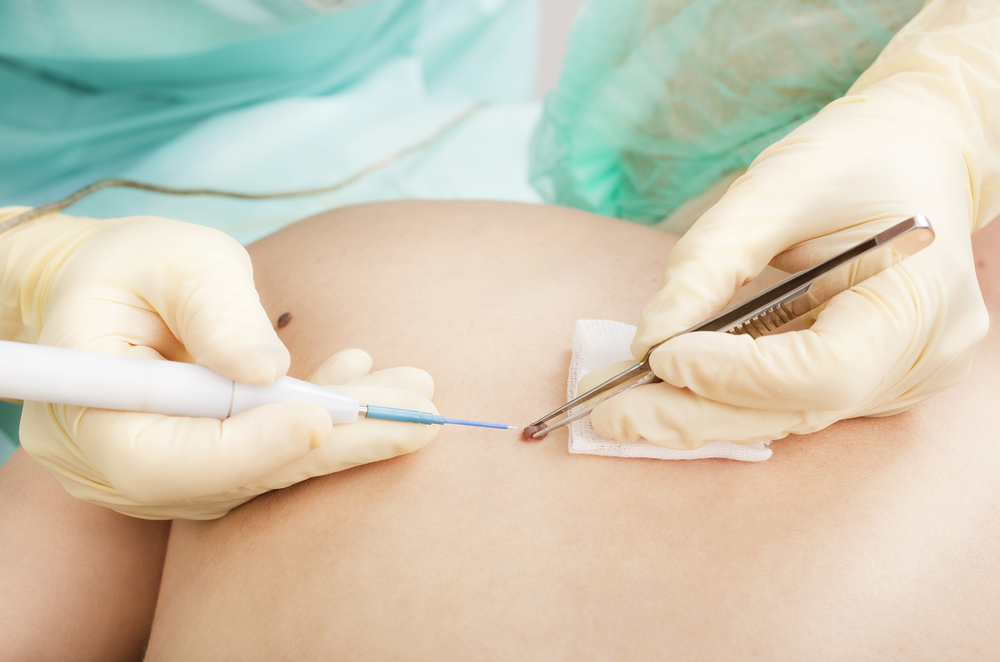 doctor removing skin cancer