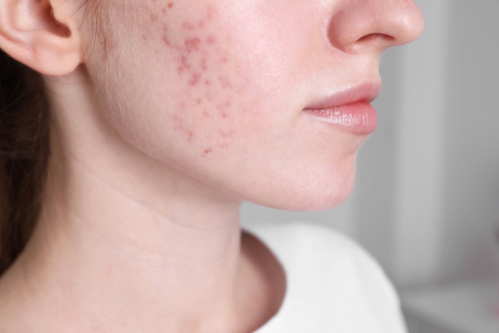 woman with acne