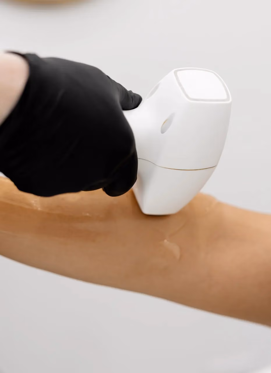 Laser Hair Removal Treatment
