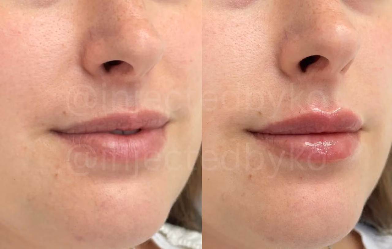 Before and After | Lips