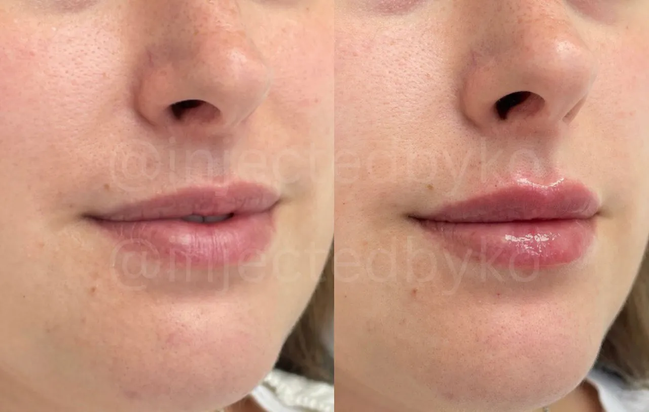 Before and After | Lips