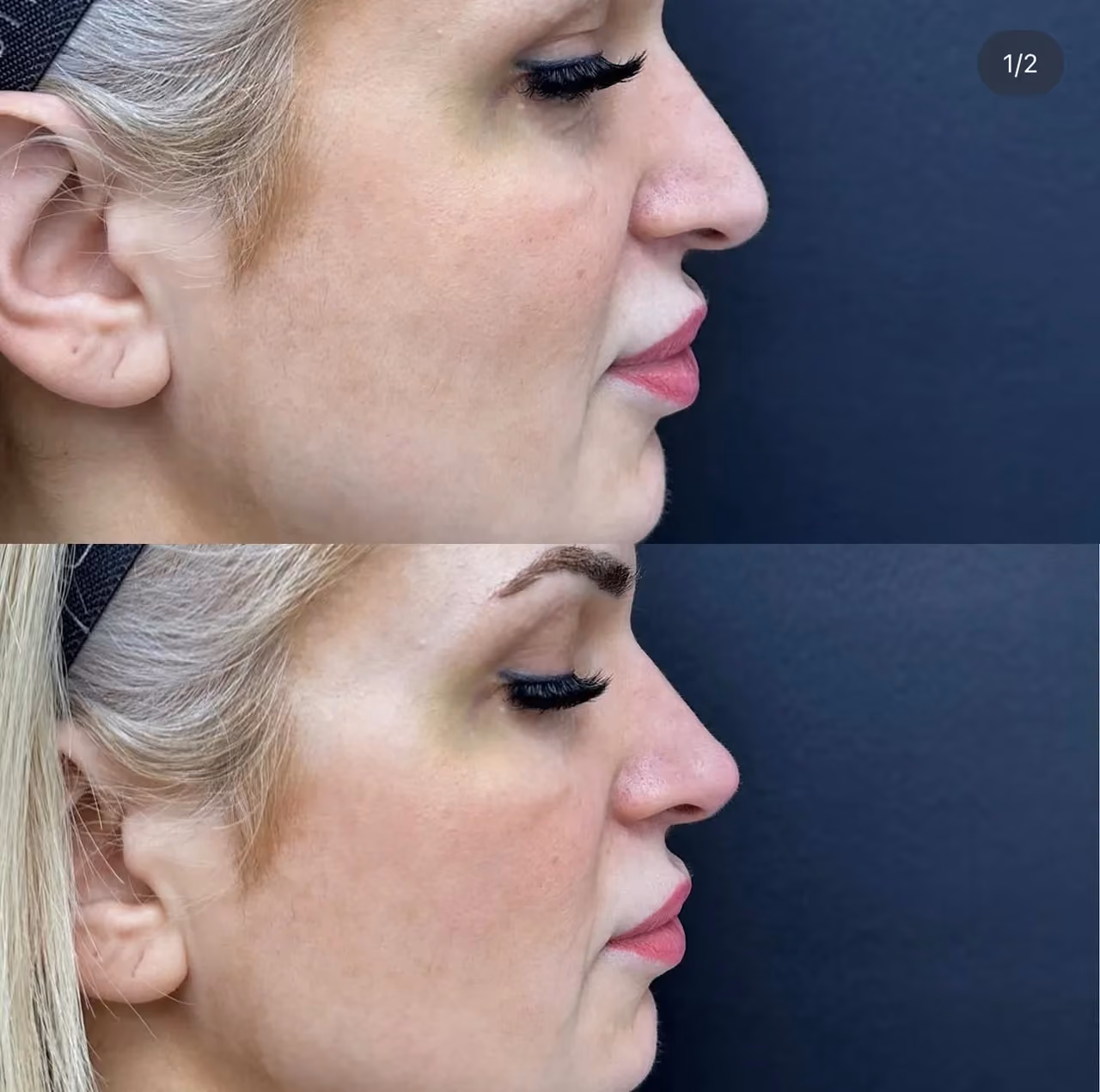 Before and After | Cheek