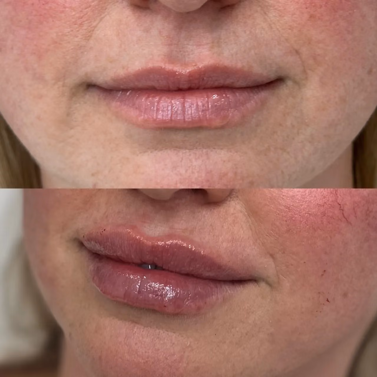 Before and After | Lips