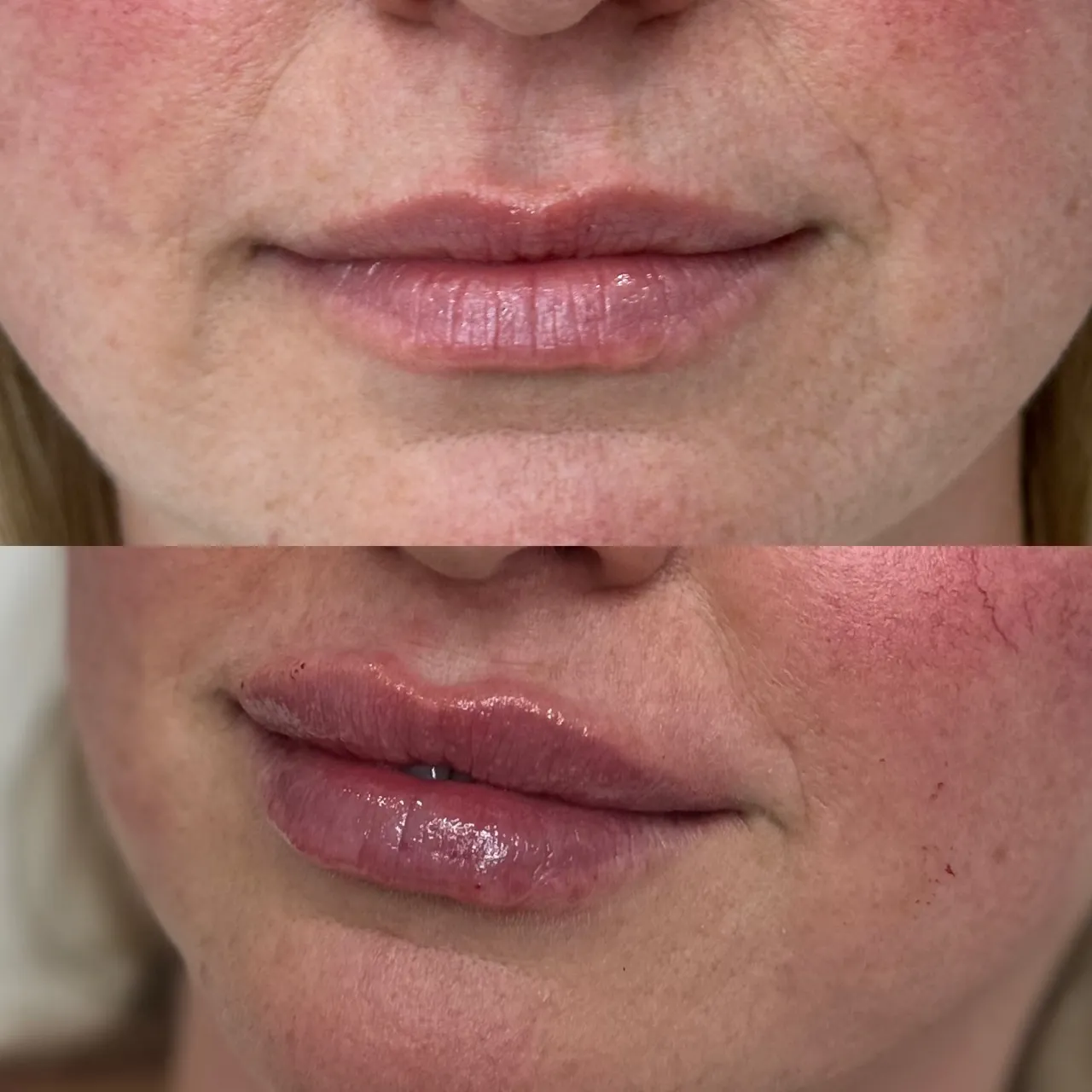 Before and After | Lips