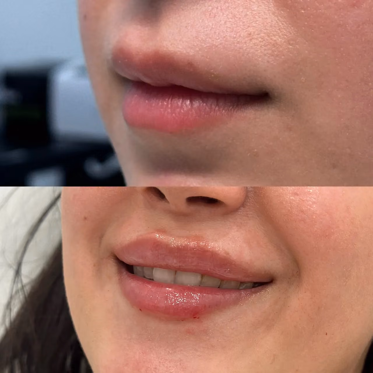 Before and After | Lips
