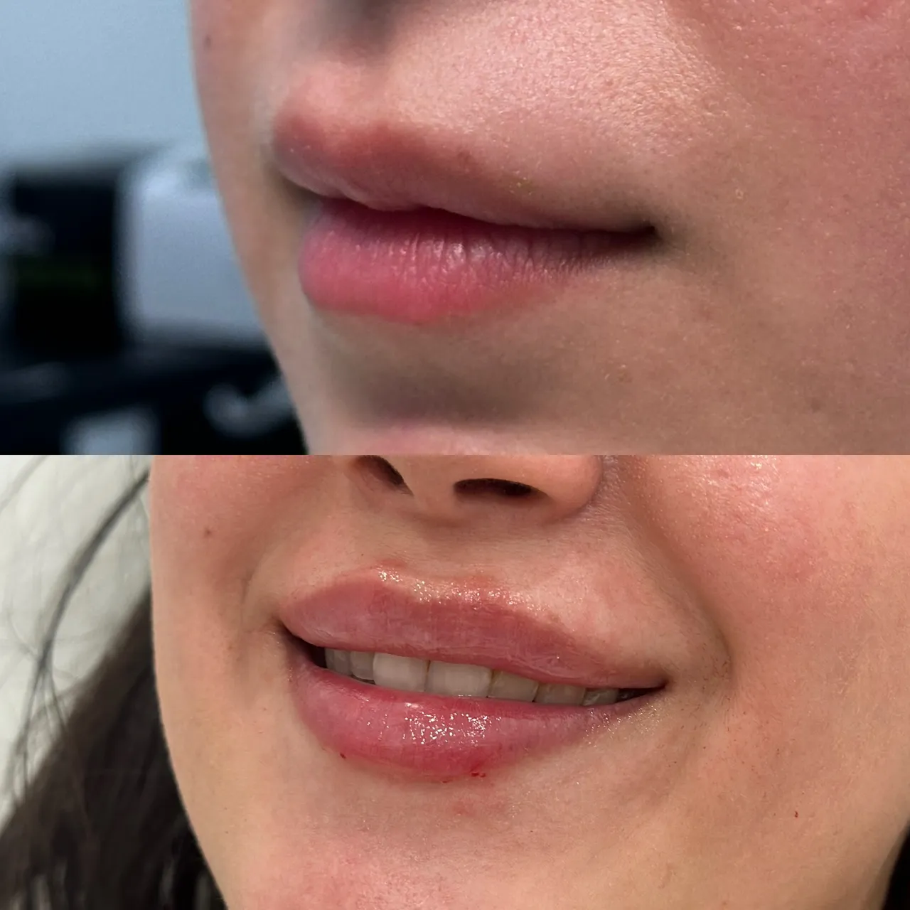 Before and After | Lips