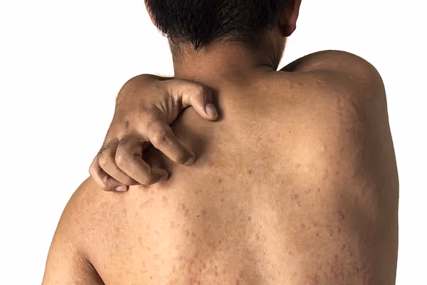 7 Back Acne Causes and How to Get Rid of Them