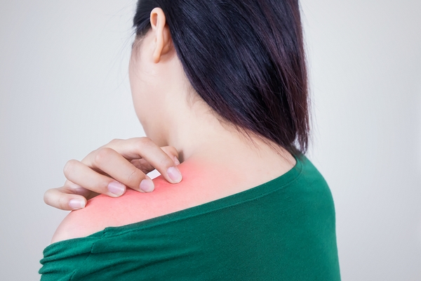 Back acne is caused by wearing tight or sweaty clothes.