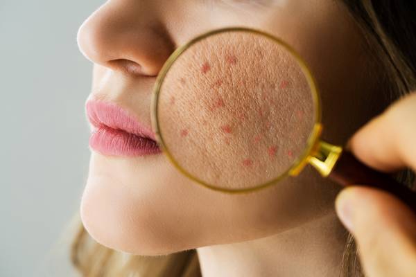 8 Best Treatments and Home Remedies for Acne Scars